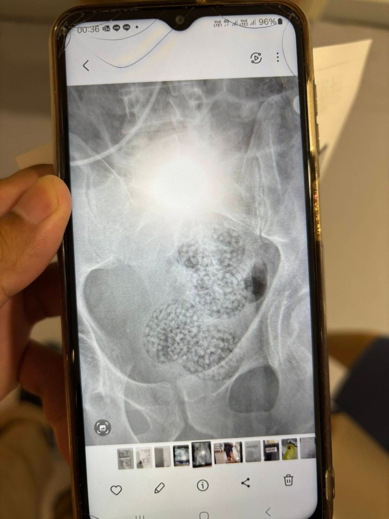 奥地利男子腹痛揭开255粒冰毒吞服谜团，疑因包装破裂