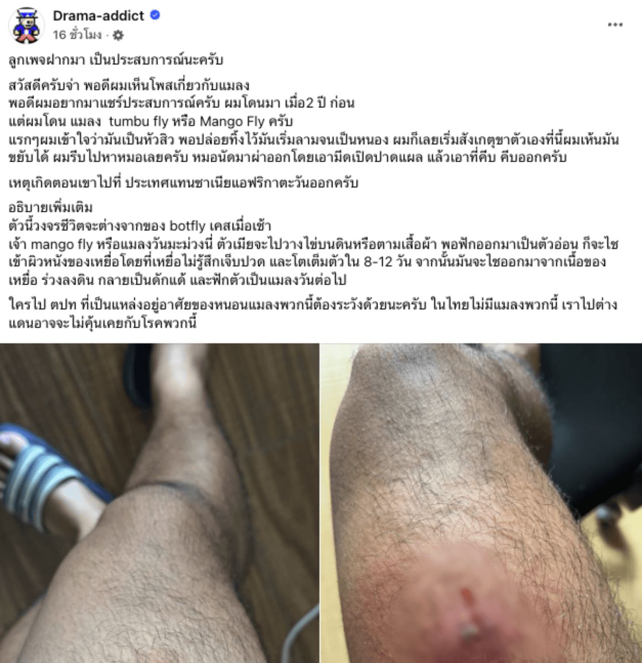 泰国男子分享芒果蝇幼虫钻入皮肤的经历，如痘痘般却能动